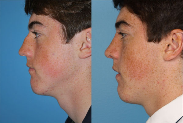 Aurora Rhinoplasty Doctors