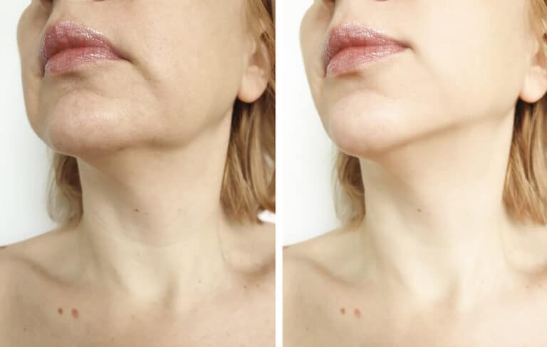 Revealing the Secrets Behind Facial and Neck Lifts for Fat Reduction