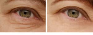 Eyelid Surgery