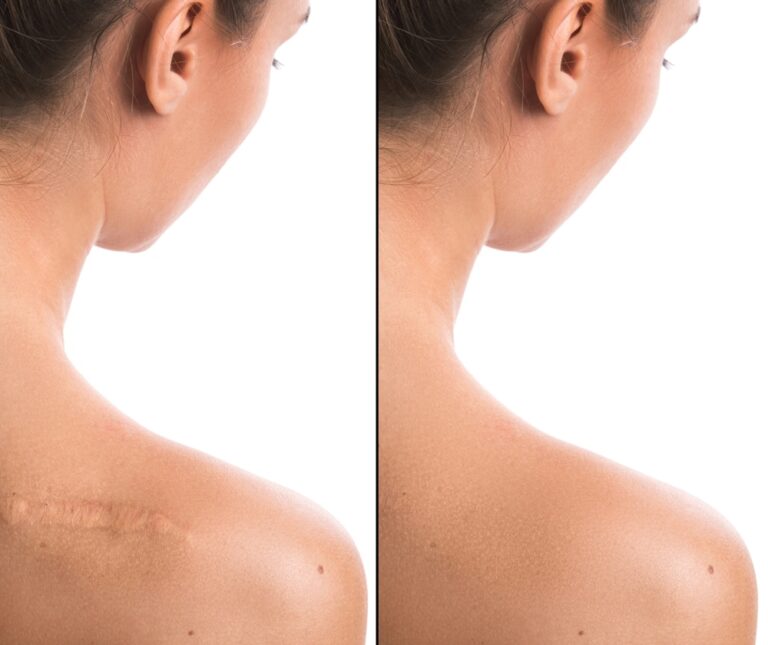 Scar Revision Surgery