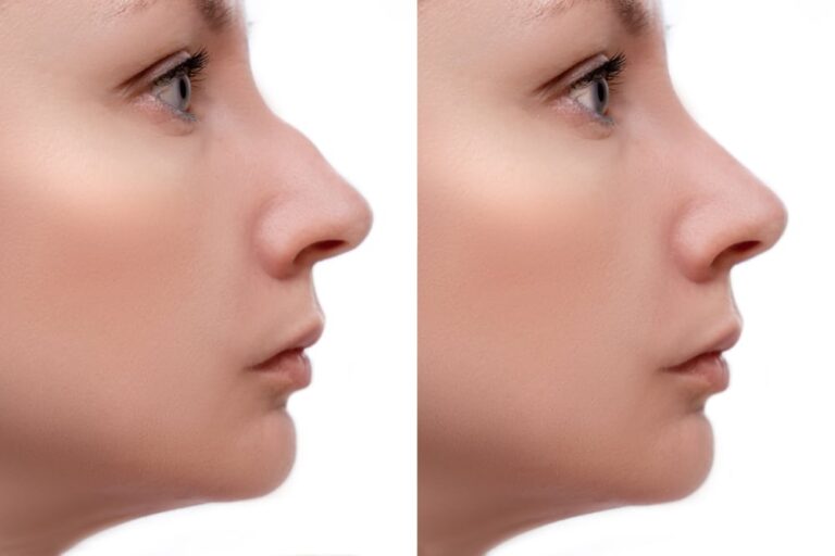 Revision Rhinoplasty
