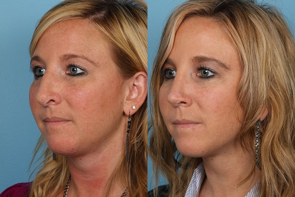 Revisions Rhinoplasty in Chicago Region