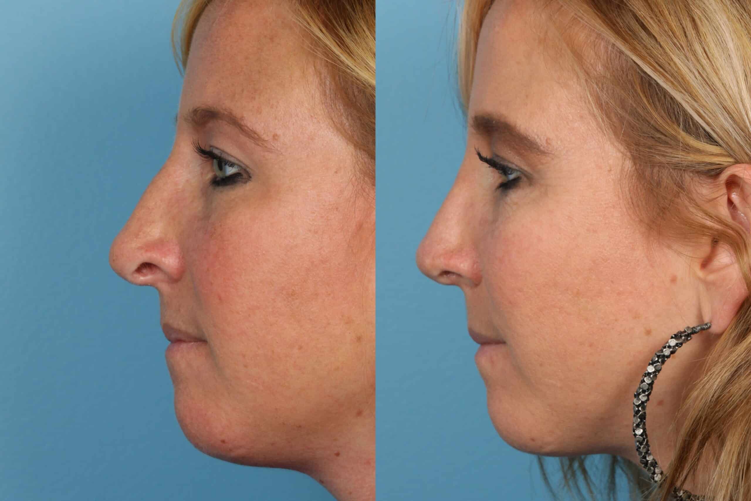 Revisions Rhinoplasty