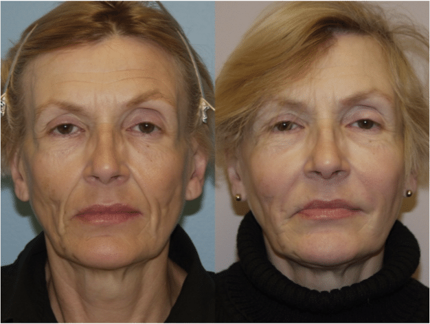 Facial Lines and Wrinkles