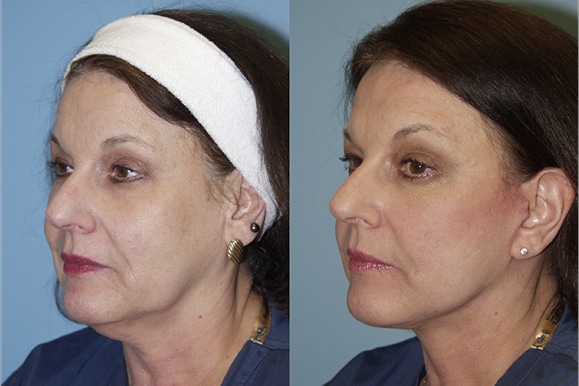 Facelifts and Necklifts
