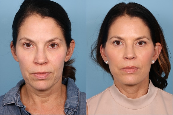 Deep Plane Face and Neck Lift, lower Blephs