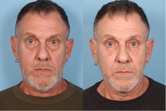 Lower Lid Blephs, Fat grafting to face, chemical peel