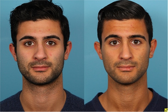 Male Rhinoplasty