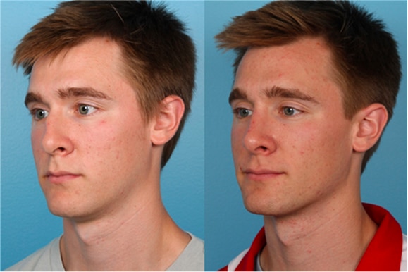 Male Rhinoplasty