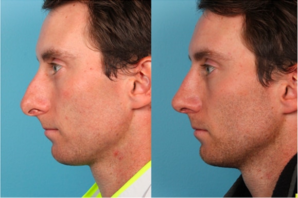 Male Rhinoplasty