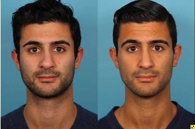 Male Rhinoplasty