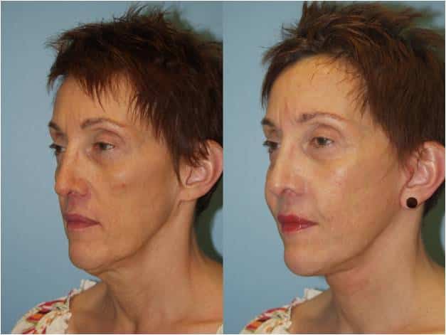 Chin and Cheek Augmentation