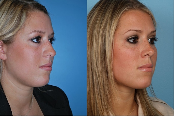 Rhinoplasty gall
