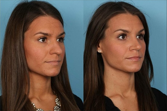 Rhinoplasty gall