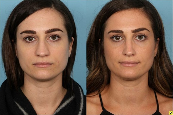 Rhinoplasty gall