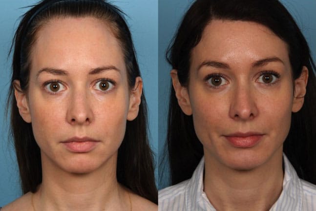 Hairline Reduction