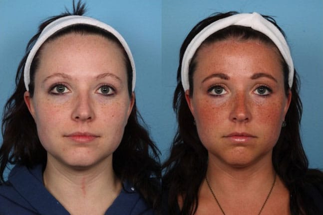 Hairline Reduction