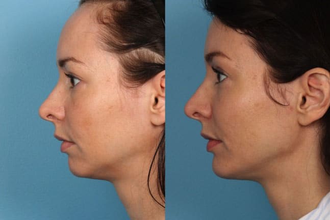 Hairline Reduction