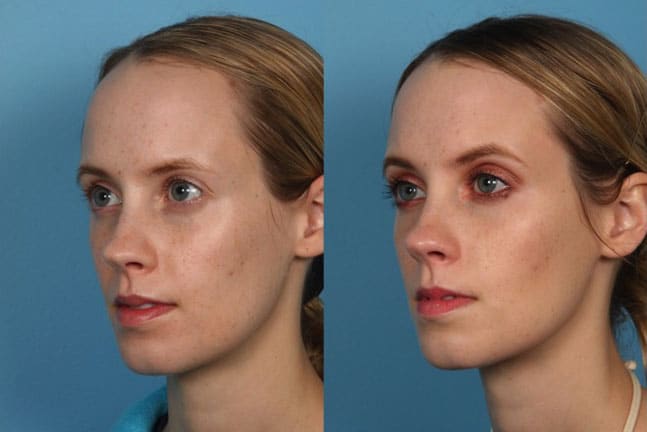 Hairline Reduction