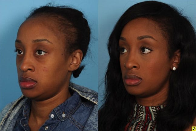 Hairline Reduction