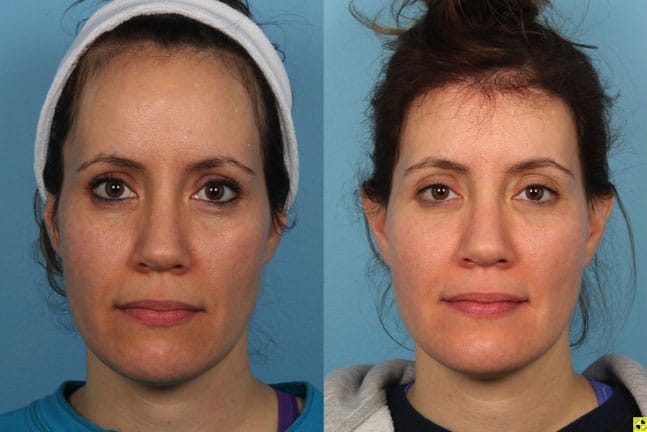 Hairline Reduction