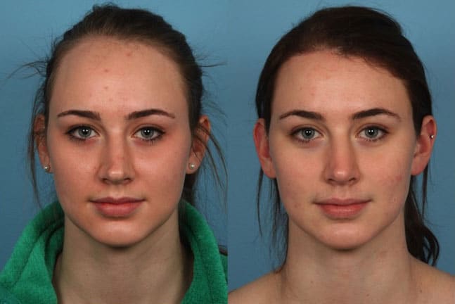 Hairline Reduction