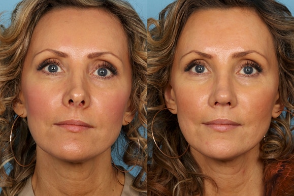 Revisions Rhinoplasty in Chicago Region