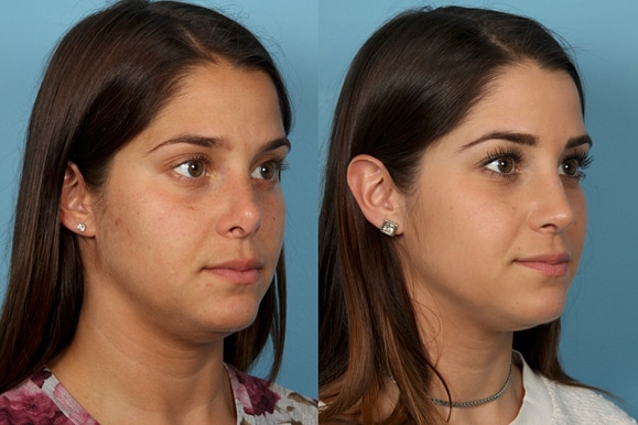 Revisions Rhinoplasty in Chicago Region