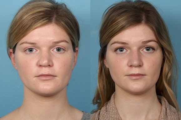 Revisions Rhinoplasty in Chicago Region