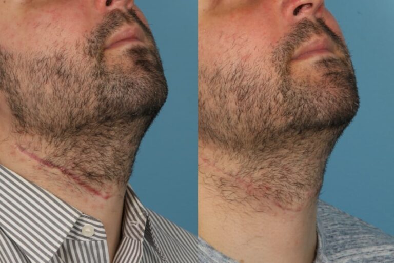 Scar Revision