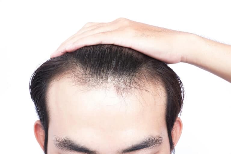 Hairline Lowering in Chicago, IL
